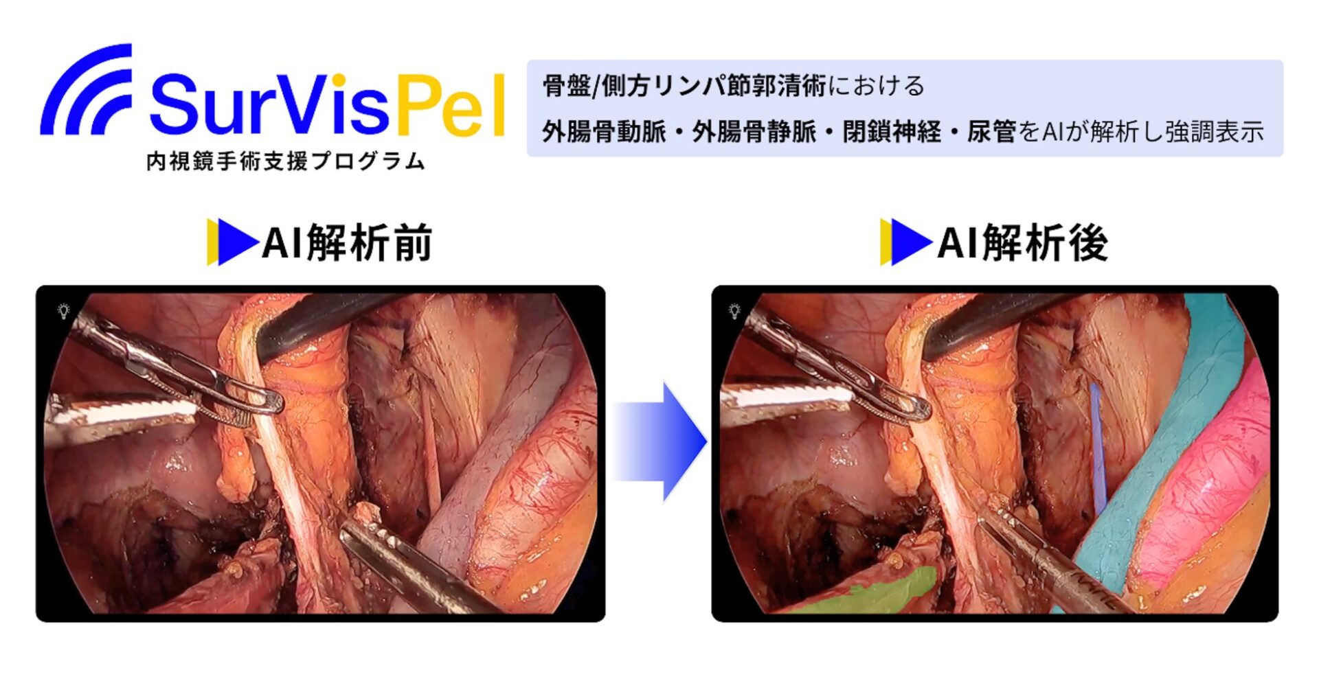 Jmees、AI内視鏡手術支援プログラム「SurVis-Pel」が薬事承認取得 - 画像1